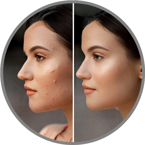 Acne Treatment