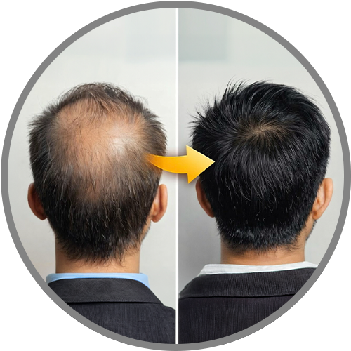 Hair loss